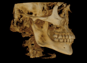 Profile view of a 3-d imaging of a skull